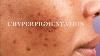 112 L Hyperpigmentation